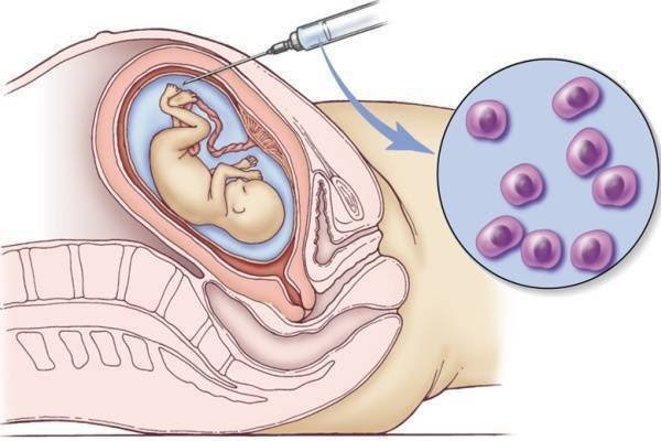 Phương pháp chọc ối xét nghiệm ADN và các thắc mắc thường gặp