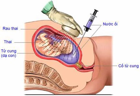 Xét nghiệm ADN xâm lấn hay còn gọi là chọc ối