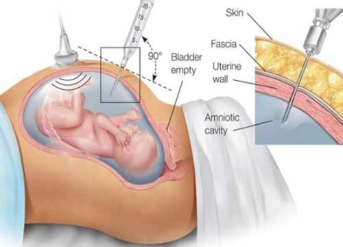 Chọc ối xét nghiệm ADN